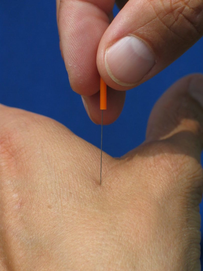 Akupunktur an der Hand